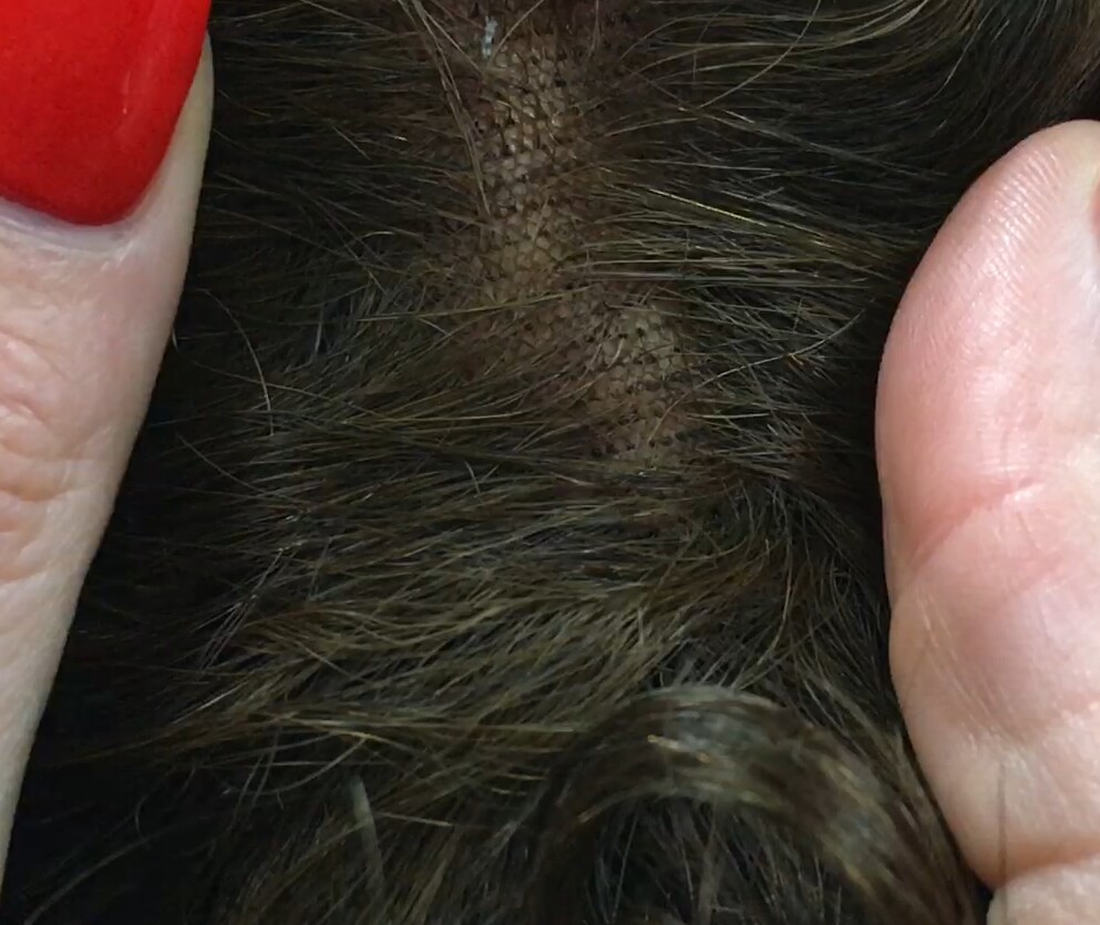 Voluminador cabello natural MINI BELINDA rizada color 5 raya de tul transparente efecto piel